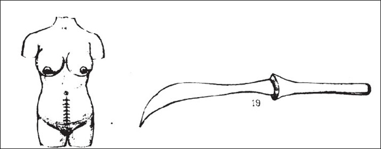 Post-caesarean wound closure and knife