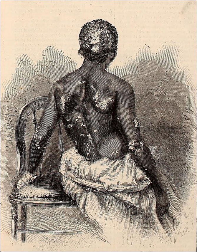 Marks of punishment inflicted upon a colored servant in Richmond, Virginia